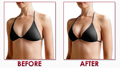 Before and after breast cream
