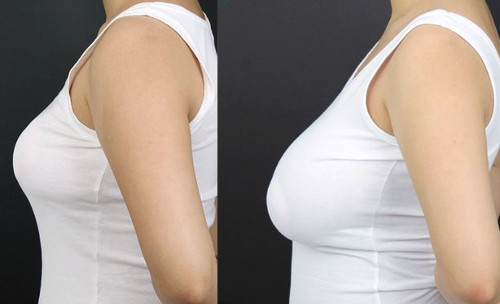 Breast Redction Surgery Before and After